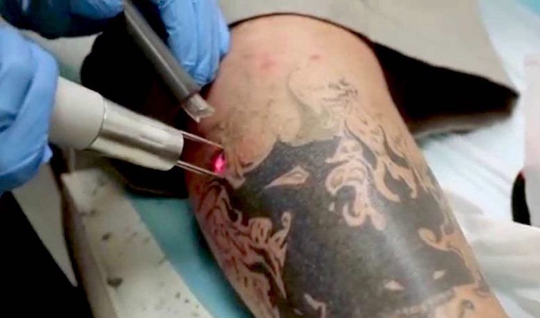Удаление татуировки лазером фото