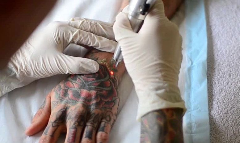 Удаление татуировки. Куда деваются чернила?