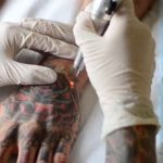 Удаление татуировки: как это делается и насколько эффективно
