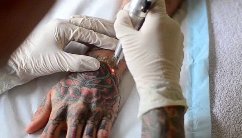 Удаление татуировки лазером фото